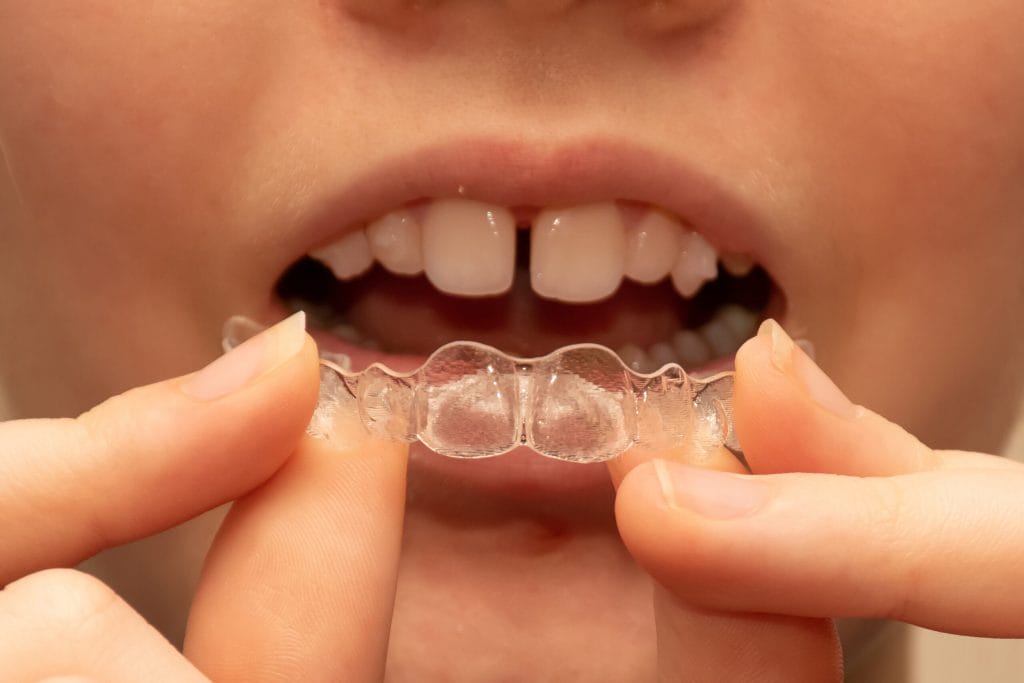 Davie Removable Braces